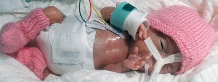 Η αγωνίστρια Emilia, το πιο μικρό πρόωρο μωρό στον κόσμο που τα κατάφερε - Εικόνα 1
