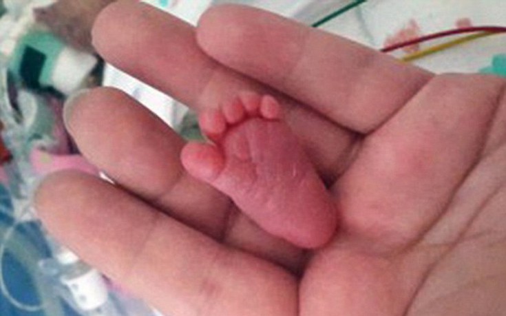 Η αγωνίστρια Emilia, το πιο μικρό πρόωρο μωρό στον κόσμο που τα κατάφερε - Εικόνα 2