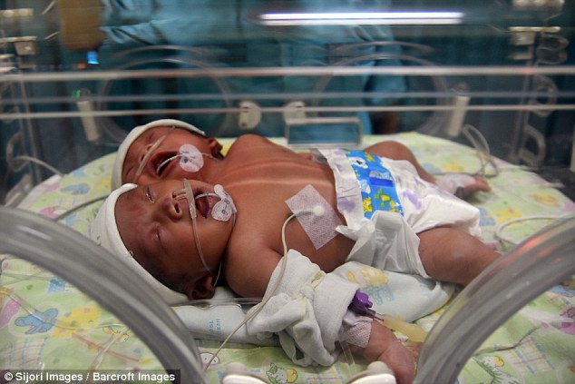 Μωρό με δύο κεφάλια γεννήθηκε στην Ινδονησία - Εικόνα 1
