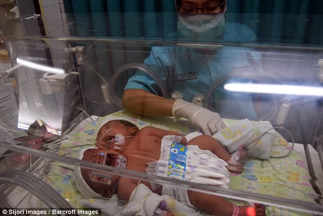 Μωρό με δύο κεφάλια γεννήθηκε στην Ινδονησία - Εικόνα 3