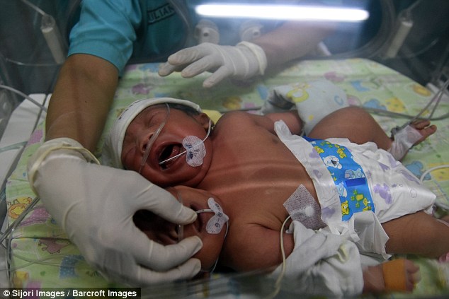 Μωρό με δύο κεφάλια γεννήθηκε στην Ινδονησία - Εικόνα 4