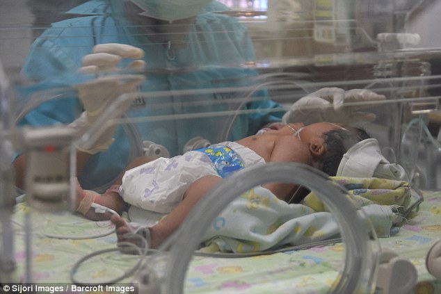 Μωρό με δύο κεφάλια γεννήθηκε στην Ινδονησία - Εικόνα 5