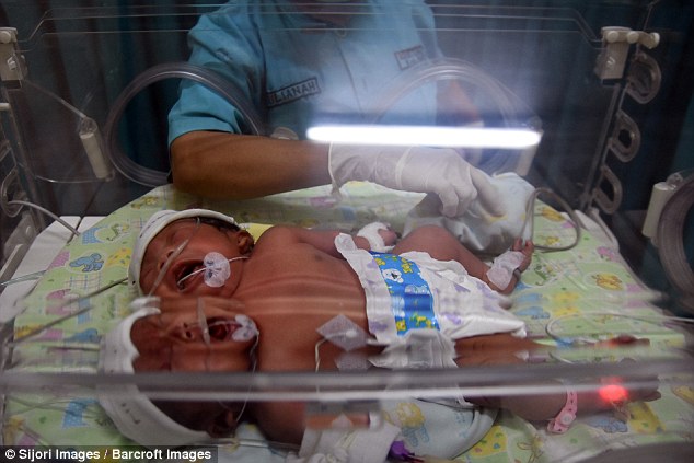 Μωρό με δύο κεφάλια γεννήθηκε στην Ινδονησία - Εικόνα 6