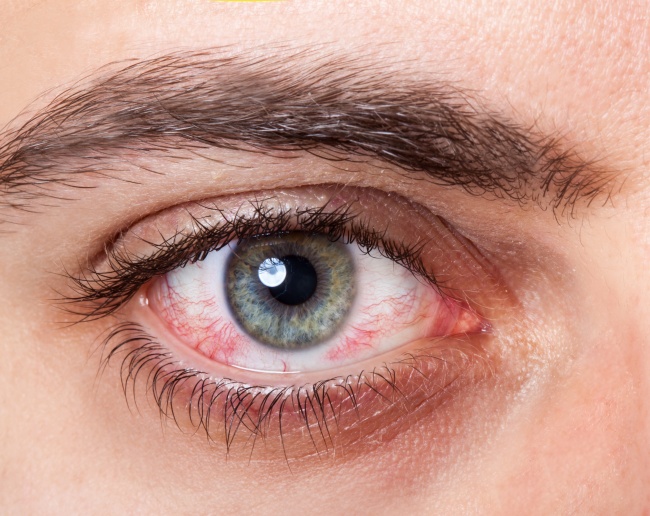 12 σημάδια που εμφανίζουν τα μάτια μας όταν έχουμε πρόβλημα με την υγεία μας - Εικόνα 3