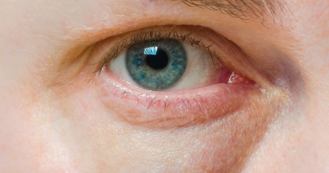 12 σημάδια που εμφανίζουν τα μάτια μας όταν έχουμε πρόβλημα με την υγεία μας - Εικόνα 6
