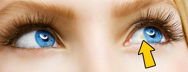 12 σημάδια που εμφανίζουν τα μάτια μας όταν έχουμε πρόβλημα με την υγεία μας - Εικόνα 7