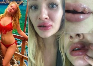 Η πανέμορφη 24χρονη δασκάλα που ήθελε σαρκώδη χείλη αλλά η πλαστική… δεν πήγε καθόλου καλά