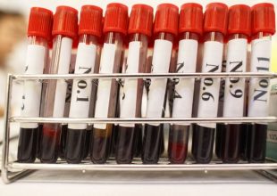 Ερευνητές επιδιώκουν τη διάγνωση της νόσου του Πάρκινσον μέσω του αίματος