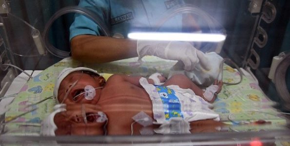 Μωρό με δύο κεφάλια γεννήθηκε στην Ινδονησία